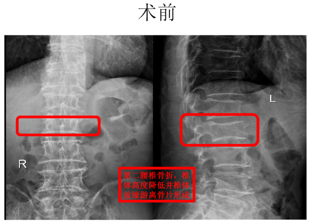 椎体成形术治疗骨质疏松性椎体骨折