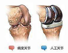 人工关节置换术