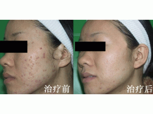 红蓝光治疗痤疮效果显著