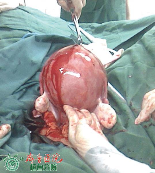 妇科肿瘤切除术.gif