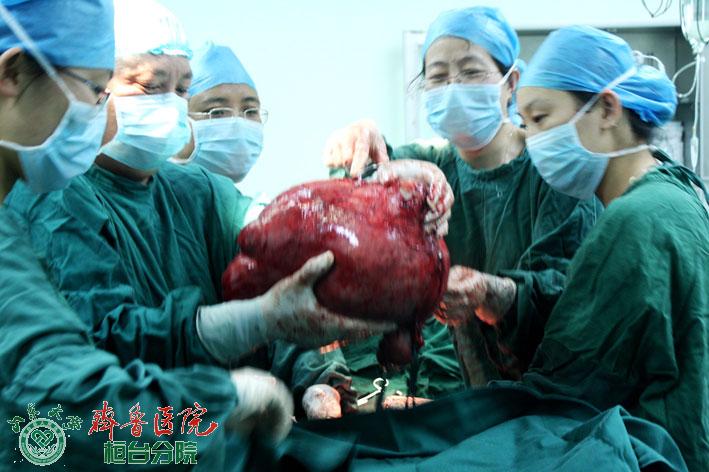 联合手术切除巨大子宫肌瘤2.jpg