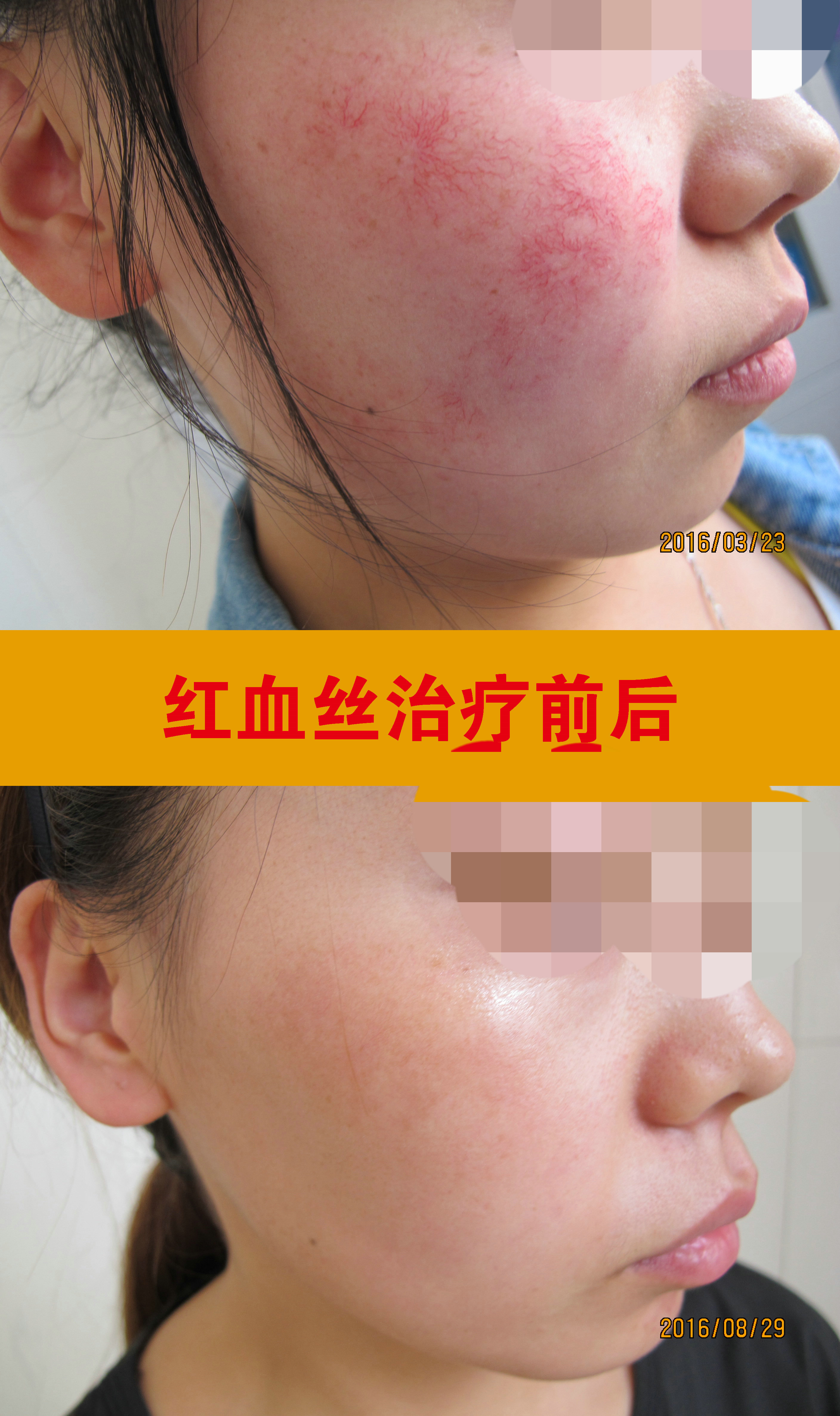 红血丝治疗前后_副本.jpg