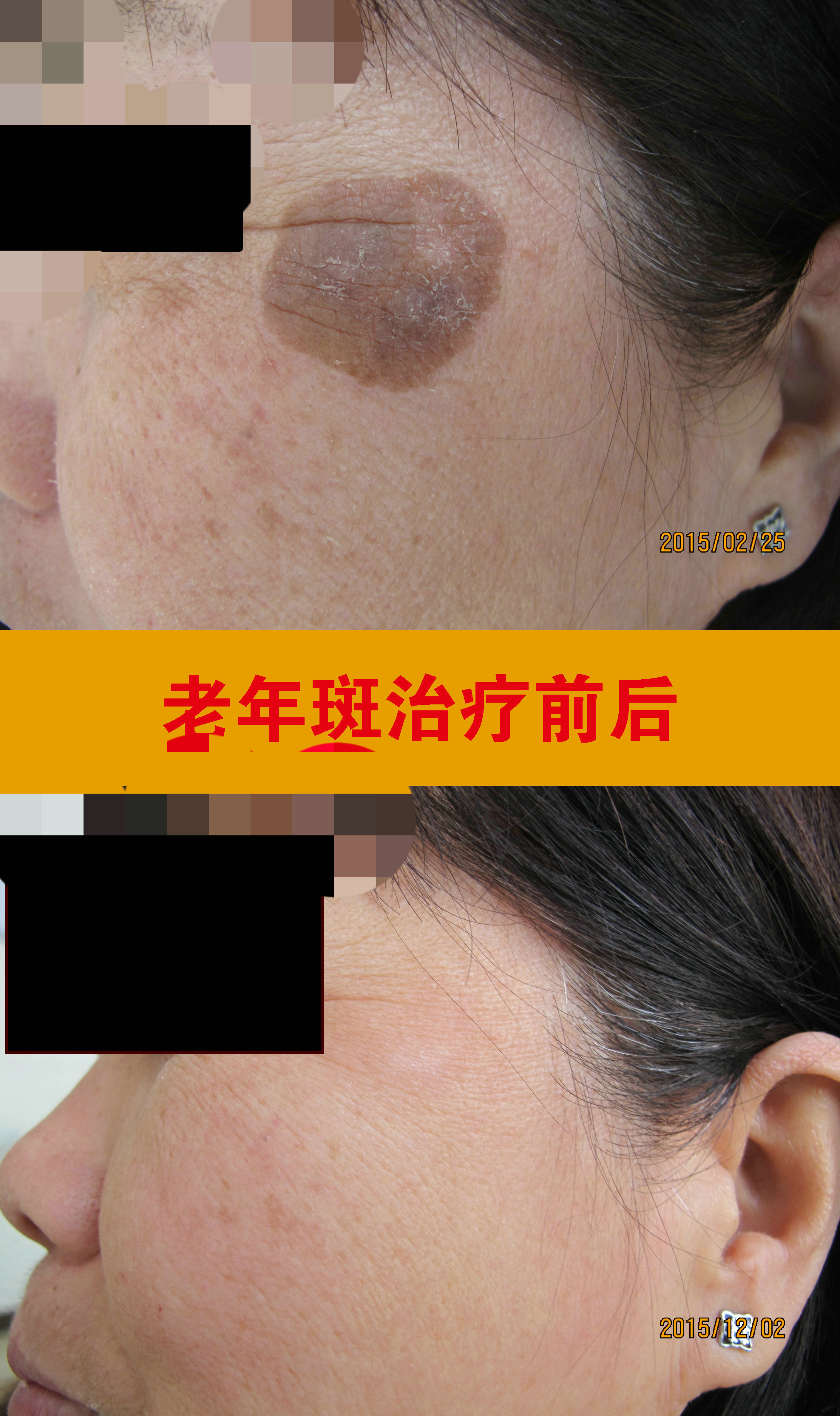 老年斑治疗前后2 (2).jpg